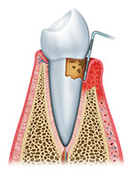 The Second Stage of Gum Disease is Periodontitis